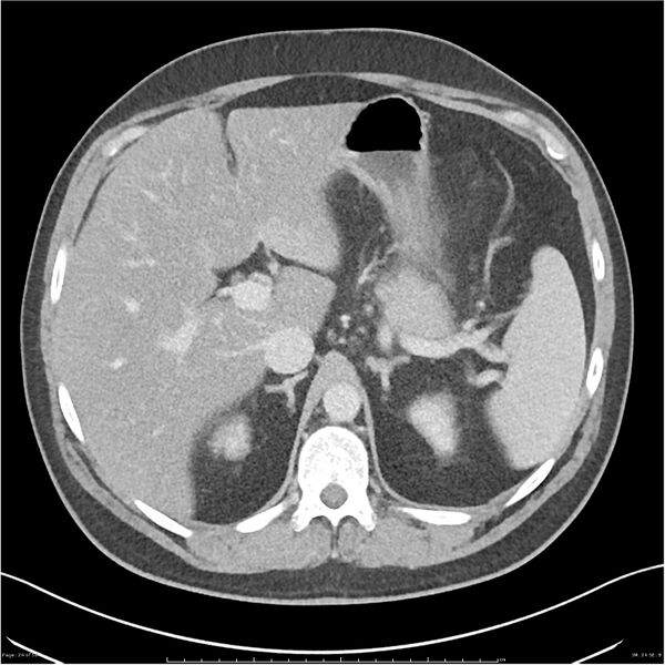 File:Acute pancreatitis - mild (Radiopaedia 27796-28033 C+ portal venous phase 5).jpg