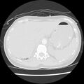 Acute pulmonary edema on CT (Radiopaedia 33582-34672 Axial lung window 53).jpg