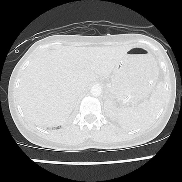 File:Acute pulmonary edema on CT (Radiopaedia 33582-34672 Axial lung window 53).jpg