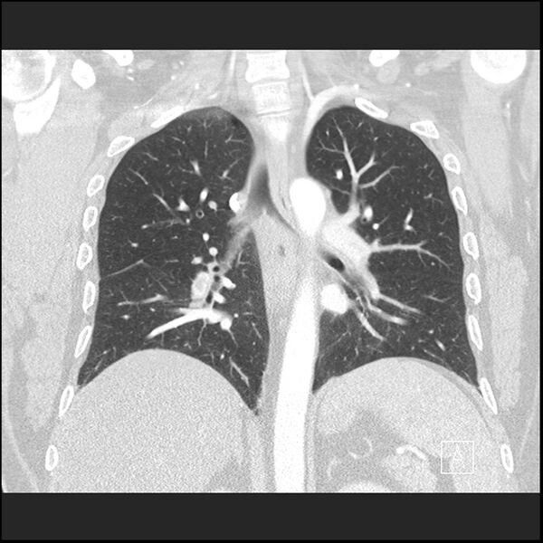 File:Acute pulmonary embolism with pulmonary infarct (Radiopaedia 73062-83768 Coronal lung window 46).jpg