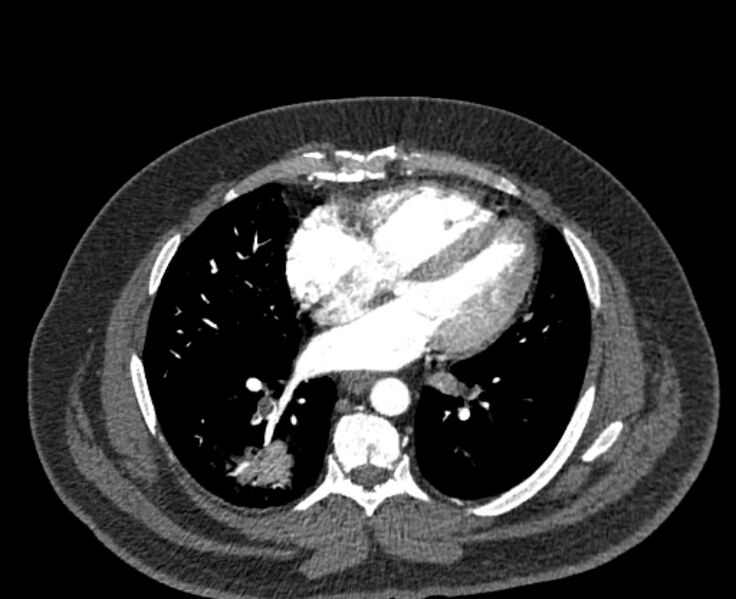 File:Acute pulmonary embolism with pulmonary infarcts (Radiopaedia 77688-89908 Axial C+ CTPA 40).jpg