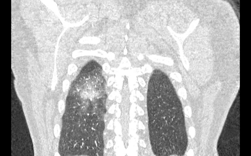 File:Acute pulmonary embolism with pulmonary infarcts (Radiopaedia 77688-89908 Coronal lung window 94).jpg