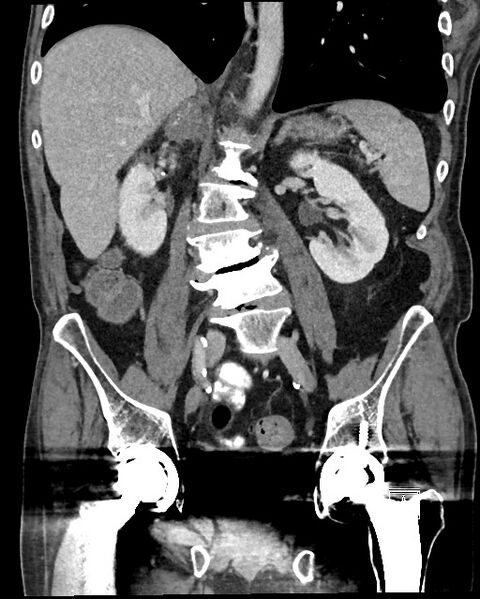 File:Acute renal infarction - rim capsular enhancement (Radiopaedia 59833-67270 Coronal C+ portal venous phase 34).jpg