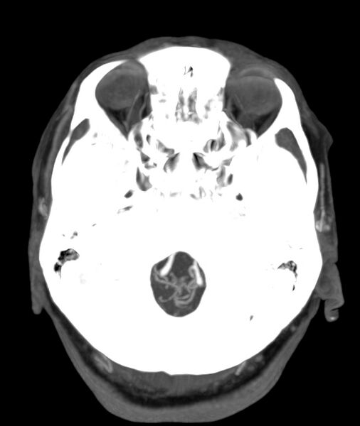 File:Acute right MCA M1 occlusion (Radiopaedia 62268-70454 Axial Phase 2 26).jpg