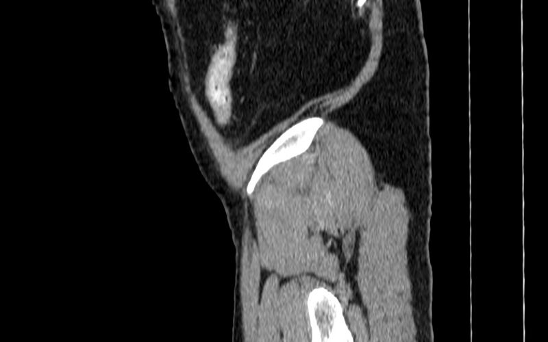 File:Acute sigmoid colon diverticulitis (Radiopaedia 55507-61976 Sagittal C+ portal venous phase 137).jpg