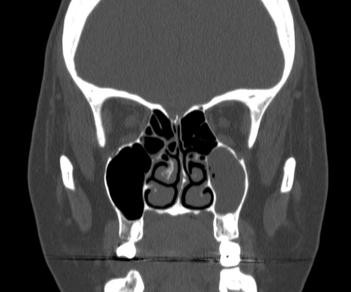 File:Acute sinusitis (Radiopaedia 22419-22455 Coronal bone window 20).jpg