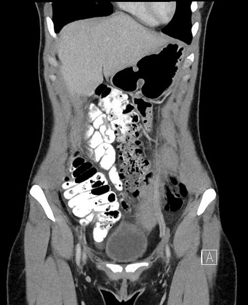 File:Acute uncomplicated appendicitis (Radiopaedia 61374-69304 Coronal C+ portal venous phase 24).jpg