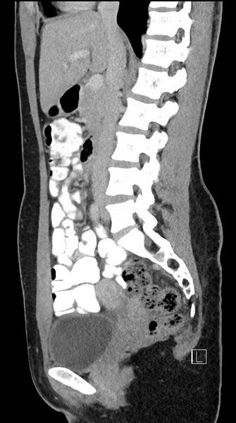 File:Acute uncomplicated appendicitis (Radiopaedia 61374-69304 Sagittal C+ portal venous phase 56).jpg