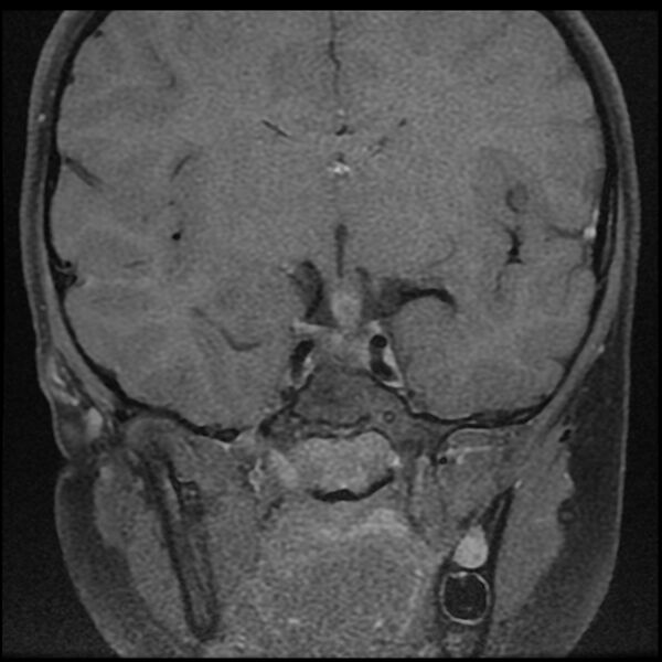 File:Adamantinomatous craniopharyngioma (Radiopaedia 77407-89529 Coronal T1 C+ fat sat 7).jpg