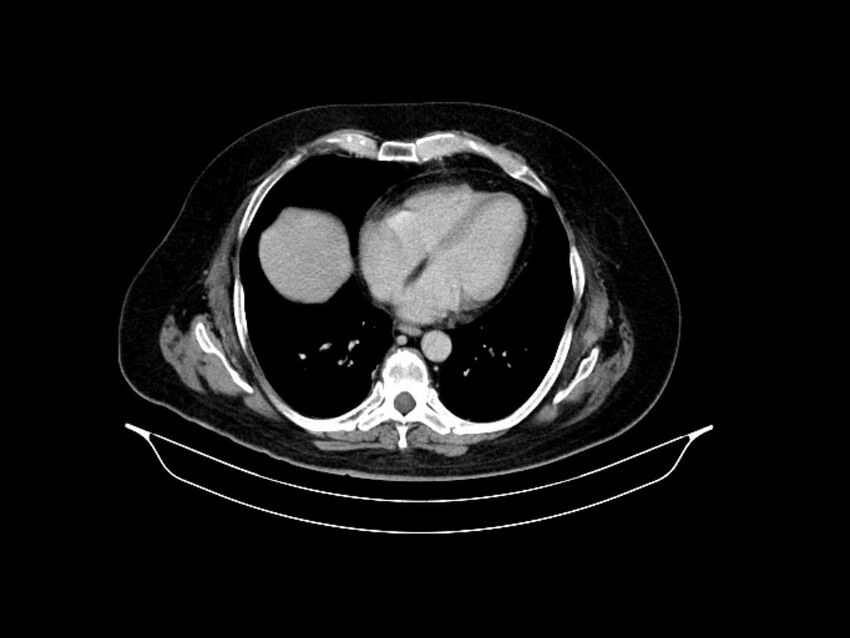 Adenocarcinoma of pancreas with hepatic metastasis (Radiopaedia 64332-73122 Axial C+ delayed 11).jpg