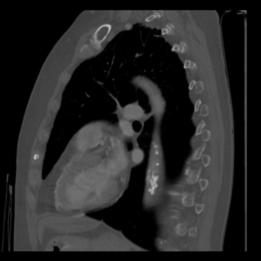 Adenocarcinoma of the lung (Radiopaedia 41015-43755 Sagittal bone window 65).jpg