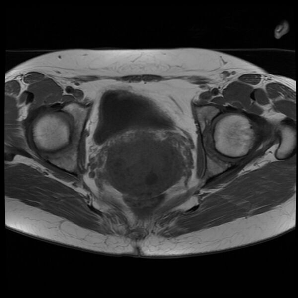 File:Adenoma malignum of the cervix (Radiopaedia 24460-24765 T1 13).jpg