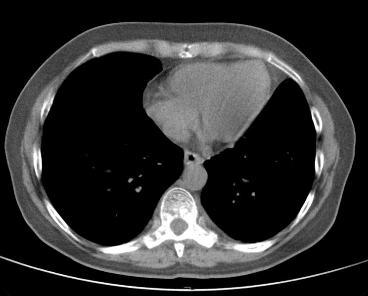 File:Adenosquamous lung carcinoma (Radiopaedia 22035-22030 non-contrast 42).jpg