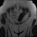 Adnexal multilocular cyst (O-RADS US 3- O-RADS MRI 3) (Radiopaedia 87426-103754 Coronal T2 4).jpg