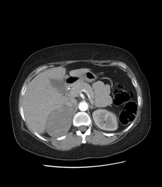 File:Adrenal cortical carcinoma with IVC invasion and thrombosis (Radiopaedia 34307-35597 Axial C+ arterial phase 26).jpg