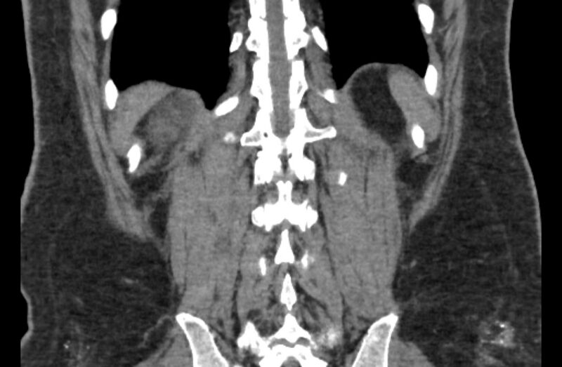 File:Adrenal myelolipoma (Radiopaedia 65240-74253 Coronal non-contrast 62).jpg
