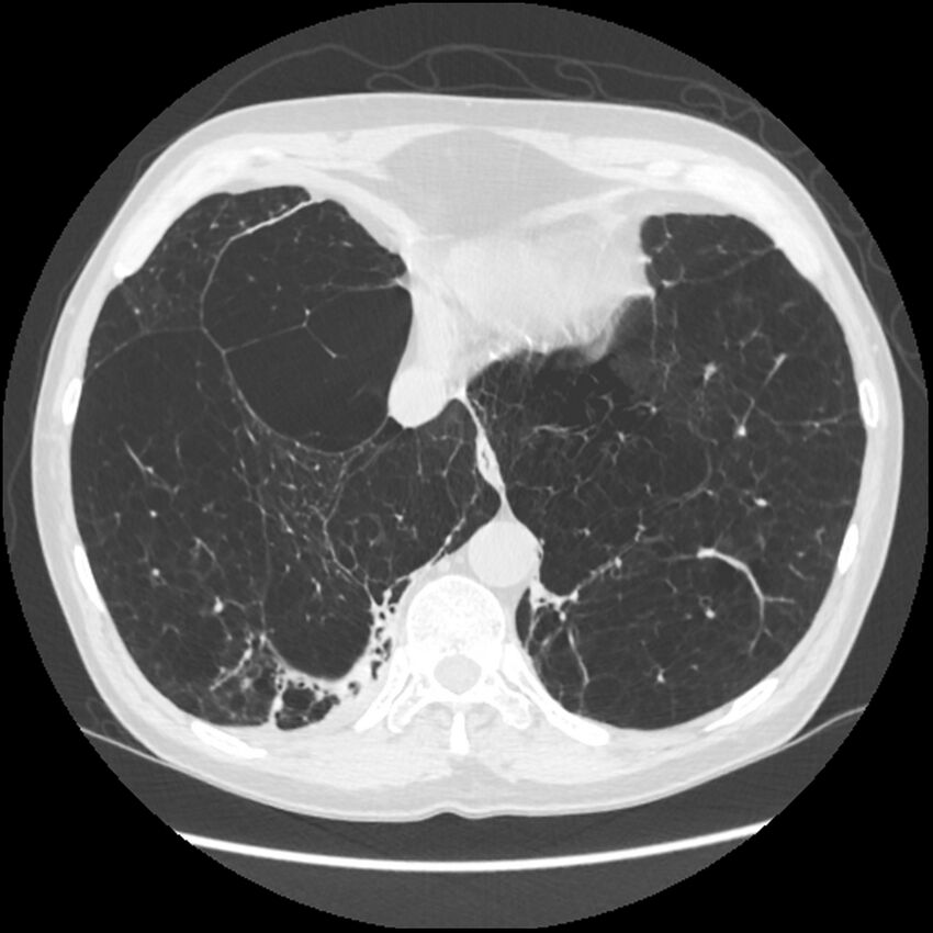 Alpha-1-antitrypsin deficiency (Radiopaedia 40993-43722 Axial lung window 194).jpg