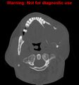 Ameloblastoma (Radiopaedia 13276-13280 Axial non-contrast 12).jpg