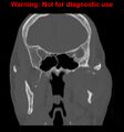 Ameloblastoma (Radiopaedia 13276-13280 Coronal non-contrast 16).jpg