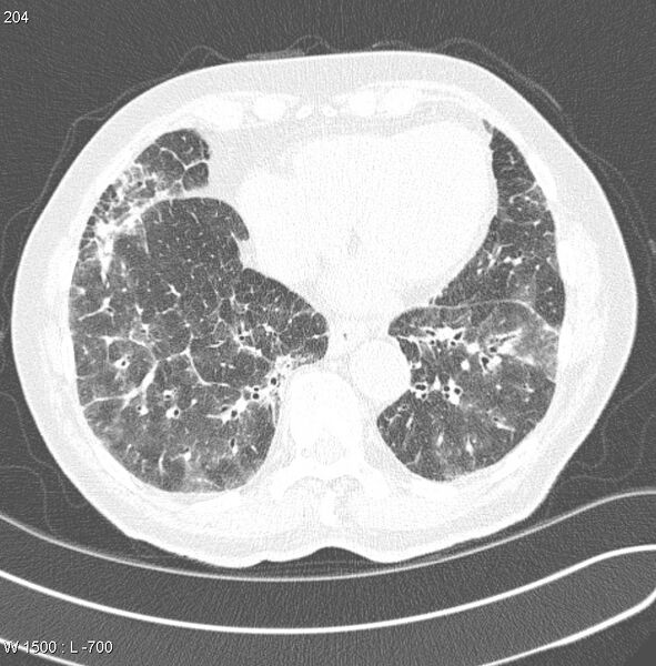 File:Amiodarone lung (Radiopaedia 6539-7851 Axial lung window 20).jpg