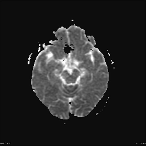File:Amnestic syndrome secondary to hypoxic brain injury (Radiopaedia 24743-25004 ADC 13).jpg