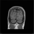 Amnestic syndrome secondary to hypoxic brain injury (Radiopaedia 24743-25004 B 4).jpg