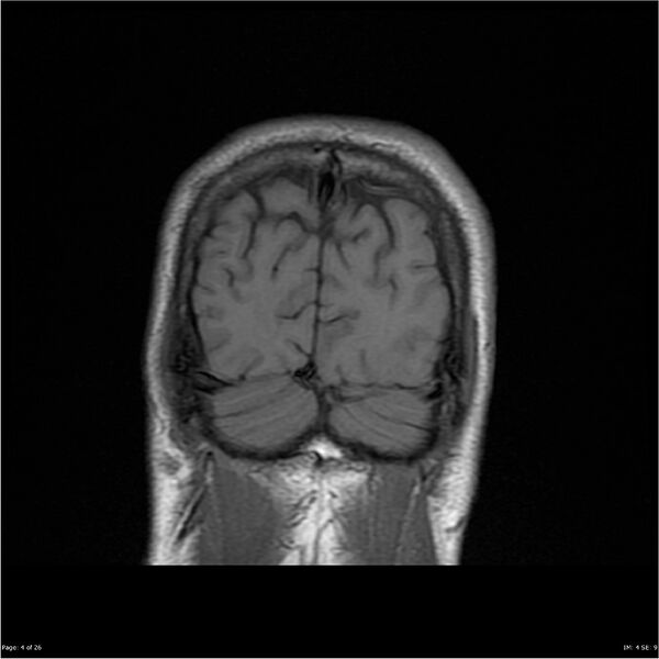 File:Amnestic syndrome secondary to hypoxic brain injury (Radiopaedia 24743-25004 B 4).jpg
