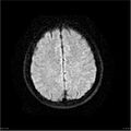 Amnestic syndrome secondary to hypoxic brain injury (Radiopaedia 24743-25004 DWI 22).jpg