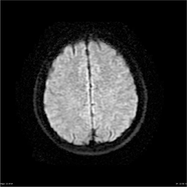 File:Amnestic syndrome secondary to hypoxic brain injury (Radiopaedia 24743-25004 DWI 22).jpg