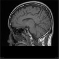 Amnestic syndrome secondary to hypoxic brain injury (Radiopaedia 24743-25004 T1 11).jpg
