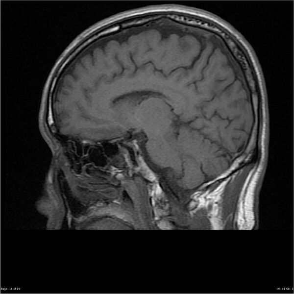File:Amnestic syndrome secondary to hypoxic brain injury (Radiopaedia 24743-25004 T1 11).jpg