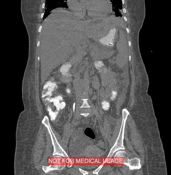 File:Amoebic enterocolitis with liver abscess (Radiopaedia 35100-36609 B 98).jpg