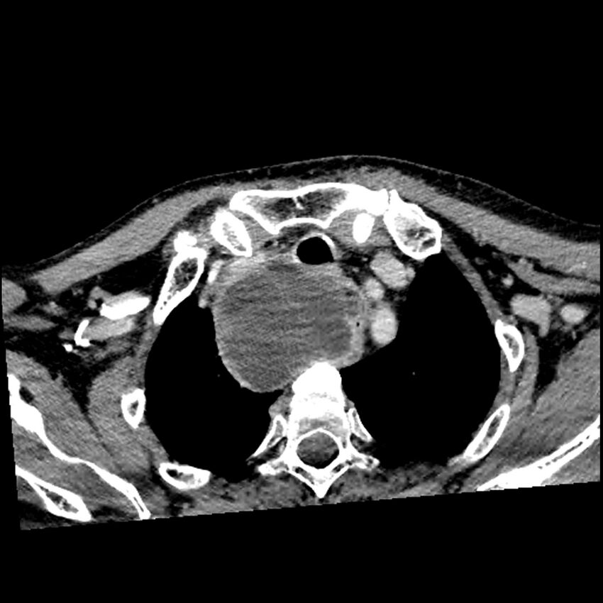 Anaplastic thyroid carcinoma (Radiopaedia 79087-92034 B 22).jpg