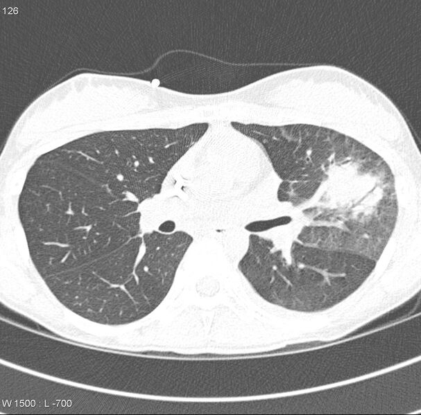 File:Angioinvasive aspergillosis (Radiopaedia 8651-9466 Axial lung window 4).jpg