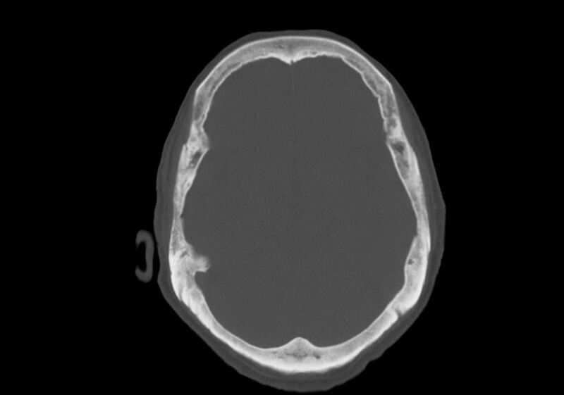 File:Anomalous intracranial venous drainage (Radiopaedia 28161-28418 Axial bone window 16).jpg