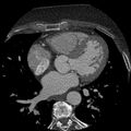 Anomalous origin of left circumflex artery from right coronary sinus (Radiopaedia 72563-83117 B 73).jpg