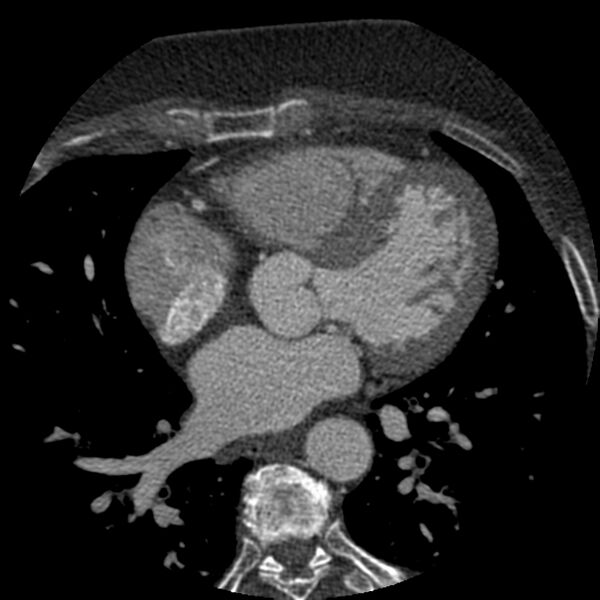 File:Anomalous origin of left circumflex artery from right coronary sinus (Radiopaedia 72563-83117 B 73).jpg