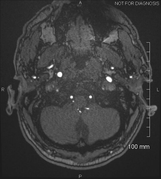 File:Anterior cerebral artery aneurysm (Radiopaedia 80683-94127 Axial MRA 15).jpg