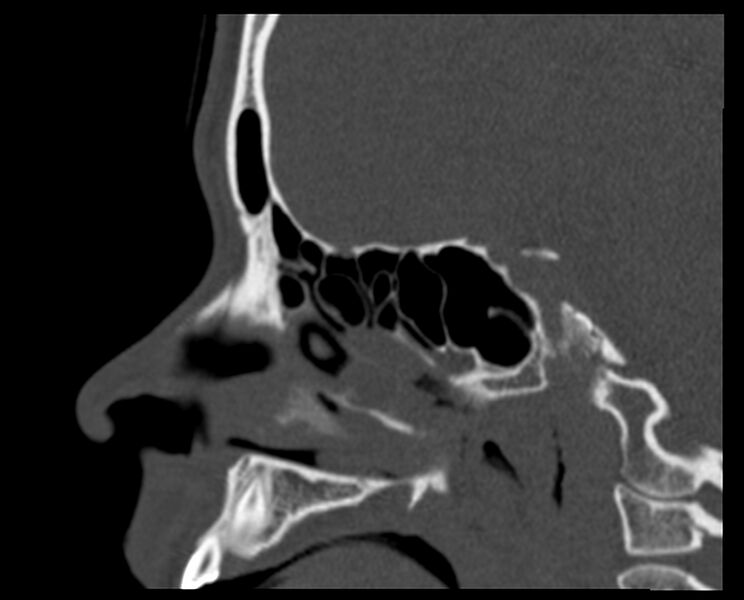 File:Antrochoanal polyp (Radiopaedia 21894-21868 Sagittal bone window 16).jpg