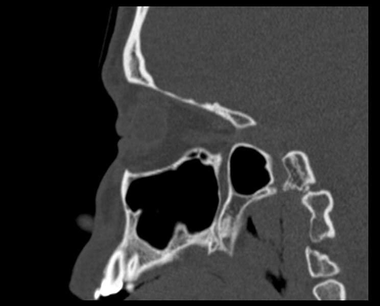 File:Antrochoanal polyp (Radiopaedia 21894-21868 Sagittal bone window 28).jpg