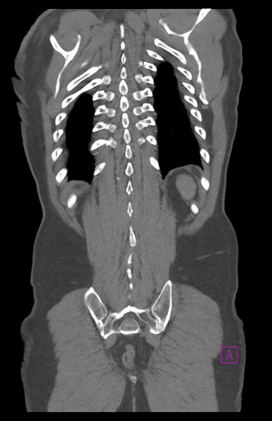 File:Aortectomy and axillary-bifemoral bypass (Radiopaedia 28303-28545 C 79).jpg