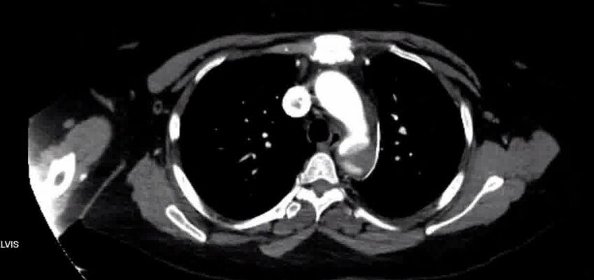 Aortic Dissection (Radiopaedia 85272-100847 A 15).jpg