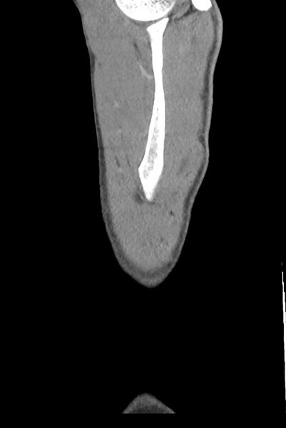 File:Aortic coarctation with aneurysm (Radiopaedia 74818-85828 B 157).jpg