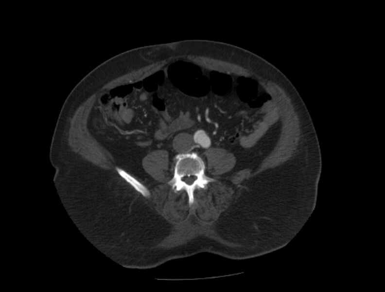 File:Aortic dissection (Radiopaedia 28802-29105 A 76).jpg
