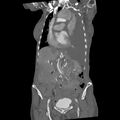 Aortic dissection (Radiopaedia 68763-78691 B 13).jpeg