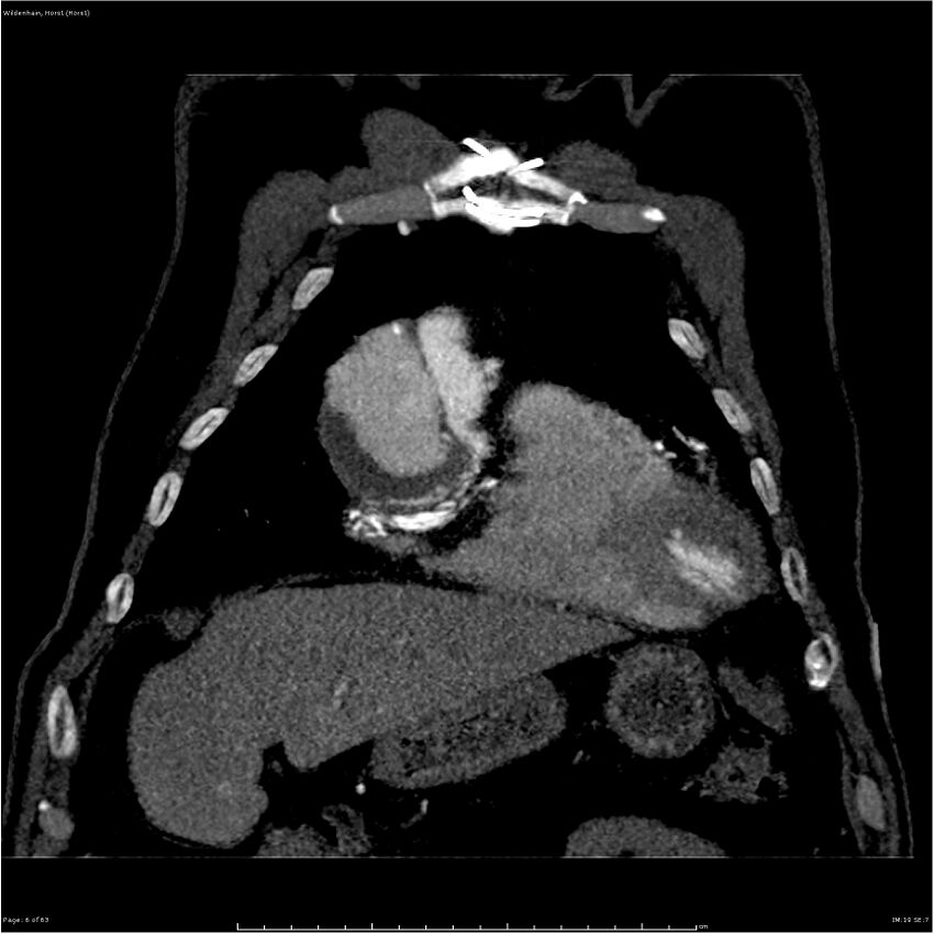 Aortic dissection - Stanford type A (Radiopaedia 26183-26315 A 6).jpg