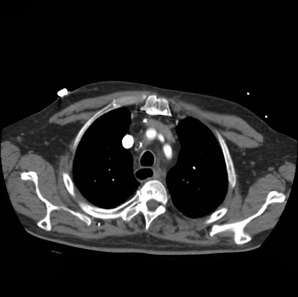 File:Aortic dissection with rupture into pericardium (Radiopaedia 12384-12647 A 13).jpg