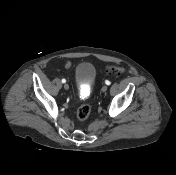 File:Aortic dissection with rupture into pericardium (Radiopaedia 12384-12647 A 81).jpg
