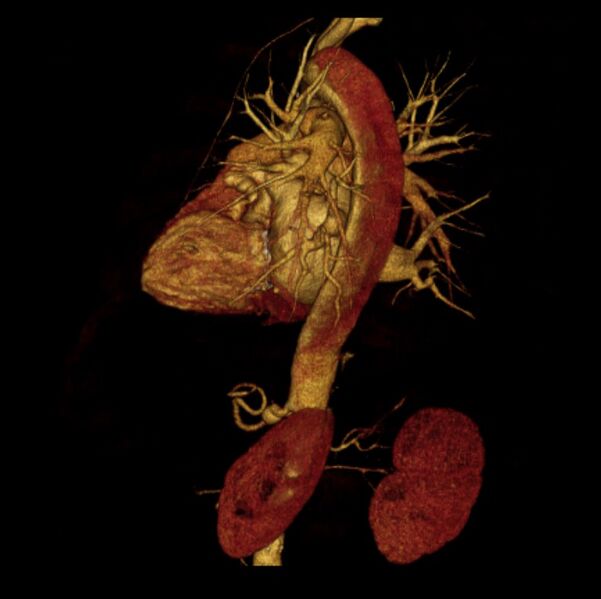 File:Aortic dissection with rupture into pericardium (Radiopaedia 12384-12647 D 24).jpg