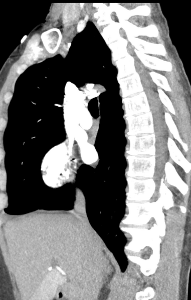 File:Aortic valve non-coronary cusp thrombus (Radiopaedia 55661-62189 C+ arterial phase 38).png